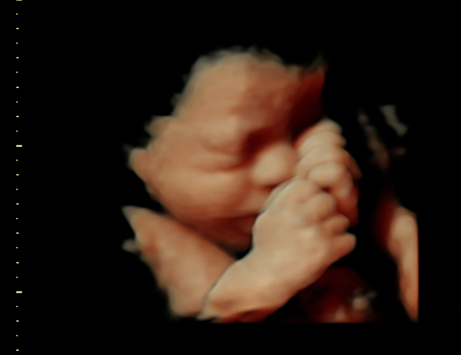 3D ultrasound image at 31 weeks